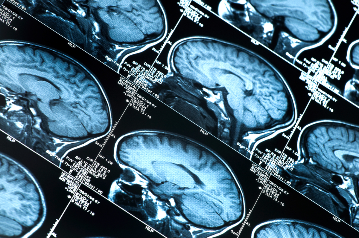Hersenscan MRI